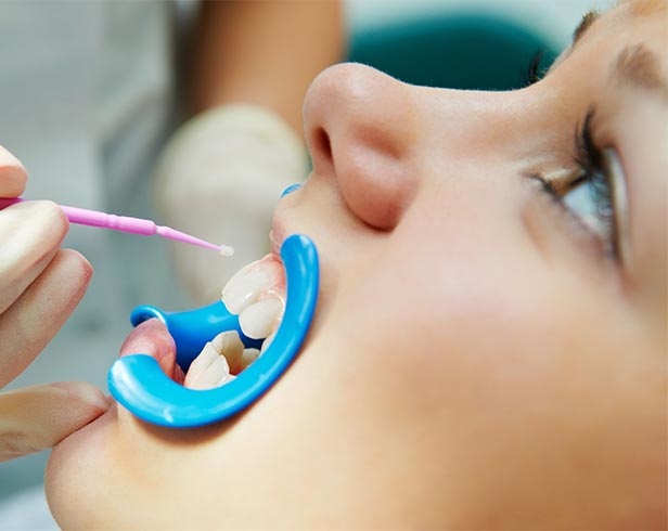 DENTAL SEALANTS