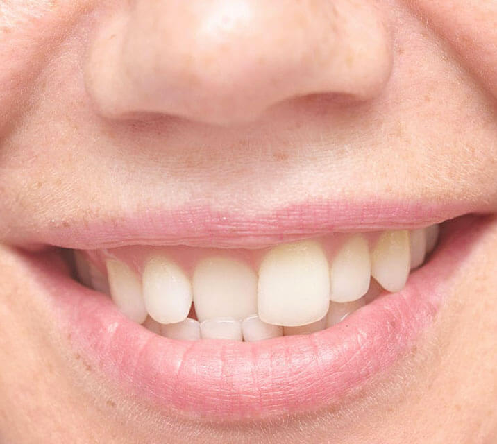 SNAP ON SMILE
