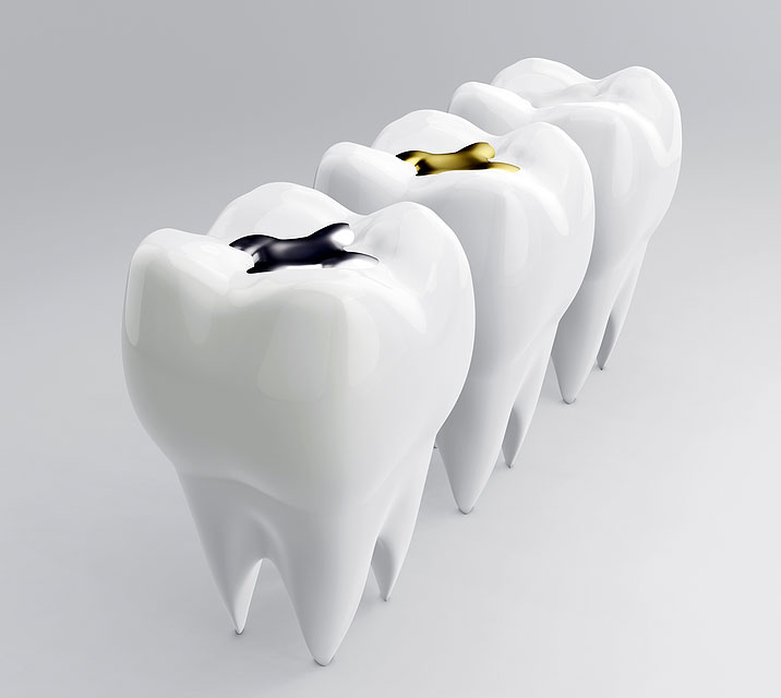 dental filling