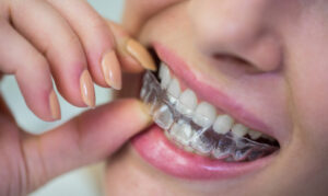 Invisalign clear aligners