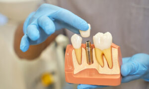 dental implants