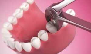 Declare Dental Independence: Surviving Tooth Extractions With A Smile