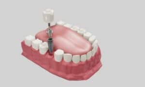 Dental Implants In Advanced Dental Center - Lincoln Park MI