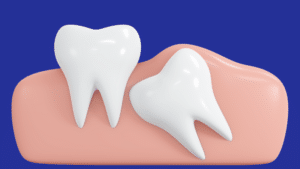 how to treat pain caused by a broken wisdom tooth