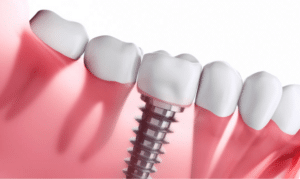 how dental implants can transform your smile and confidence