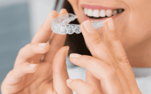 Invisalign Aligners