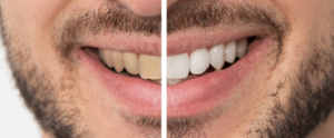 Professional Teeth Whitening: Smile Brighter This Valentine’s Day