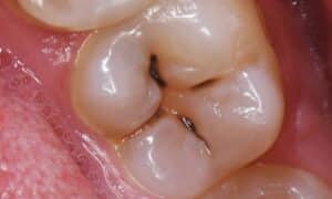 How To Prevent Cavities: Essential Tips And Techniques