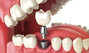 What You Might Need Before Getting Dental Implants?