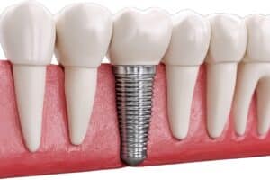 dental-implants-in-Lincoln-Park